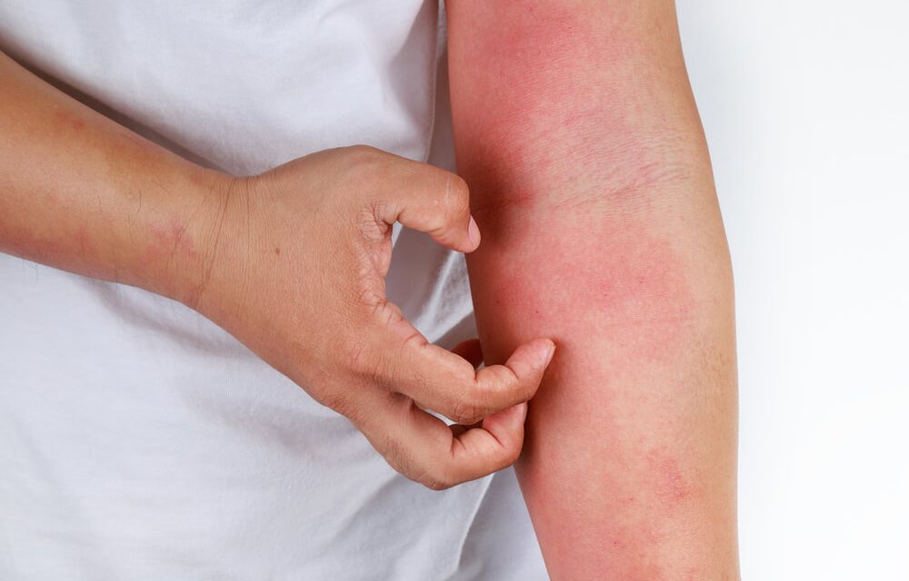 Atopijski dermatitis: kako ga prepoznati i liječiti