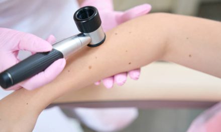 Kako se radi digitalna dermatoskopija i koje su njene prednosti u odnosu na klasičnu?