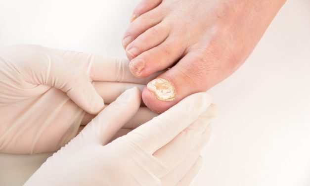 Stručni vodič za prevenciju, razumijevanje i liječenje gljivica na nogama