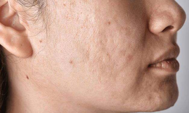 Lasersko uklanjanje ožiljaka od akni: revolucionarni pristup obnavljanju kože 