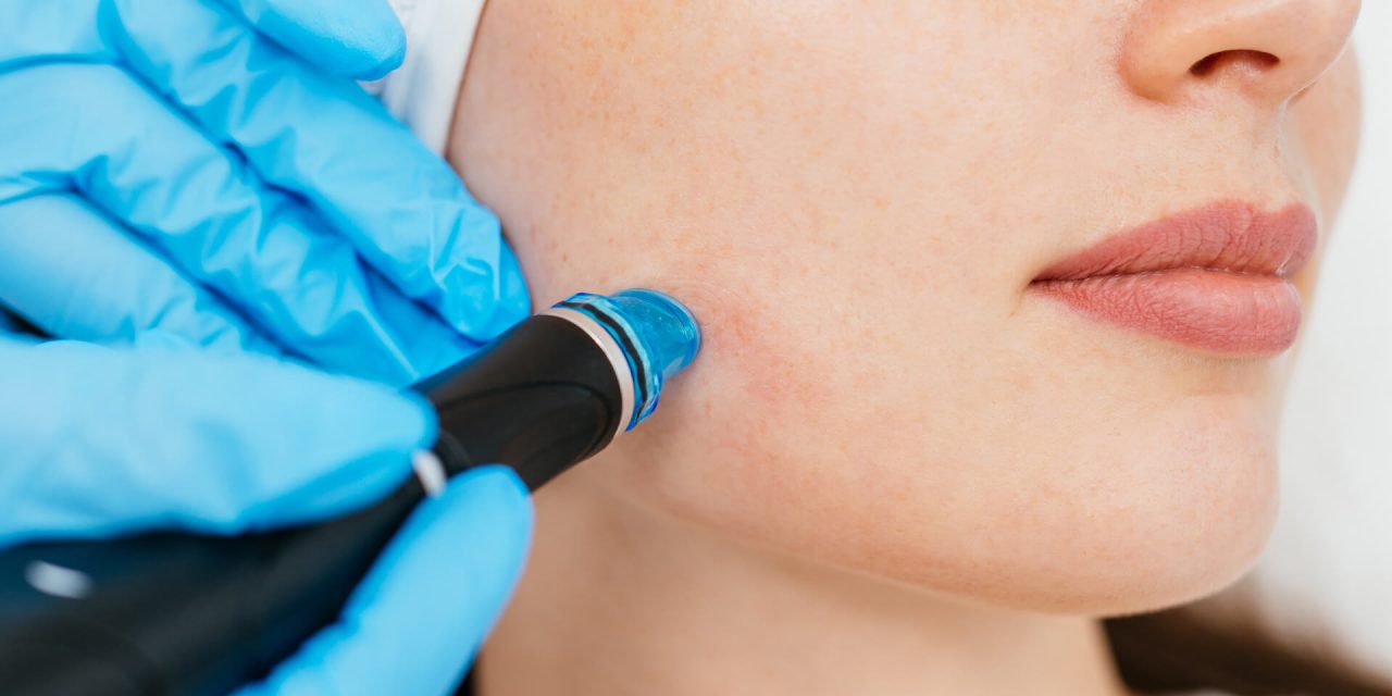 Microneedling: Tretman za zdravu i obnovljenu kožu