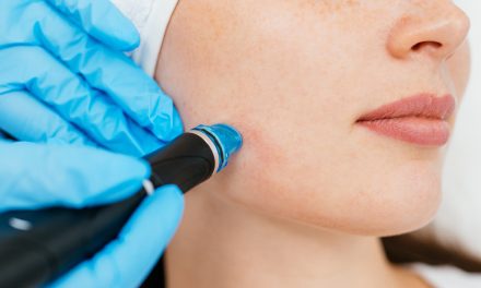 Microneedling: Tretman za zdravu i obnovljenu kožu