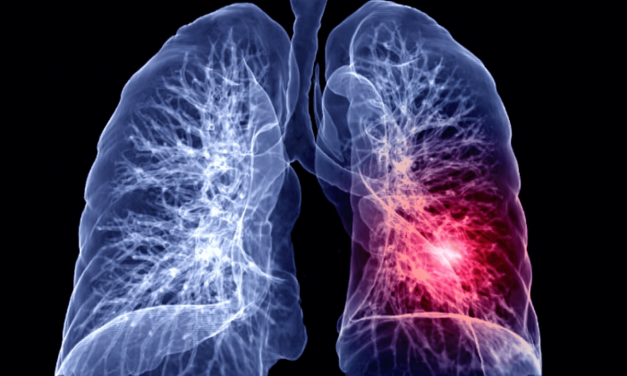 Kako nastaje embolija pluća – patofiziologija