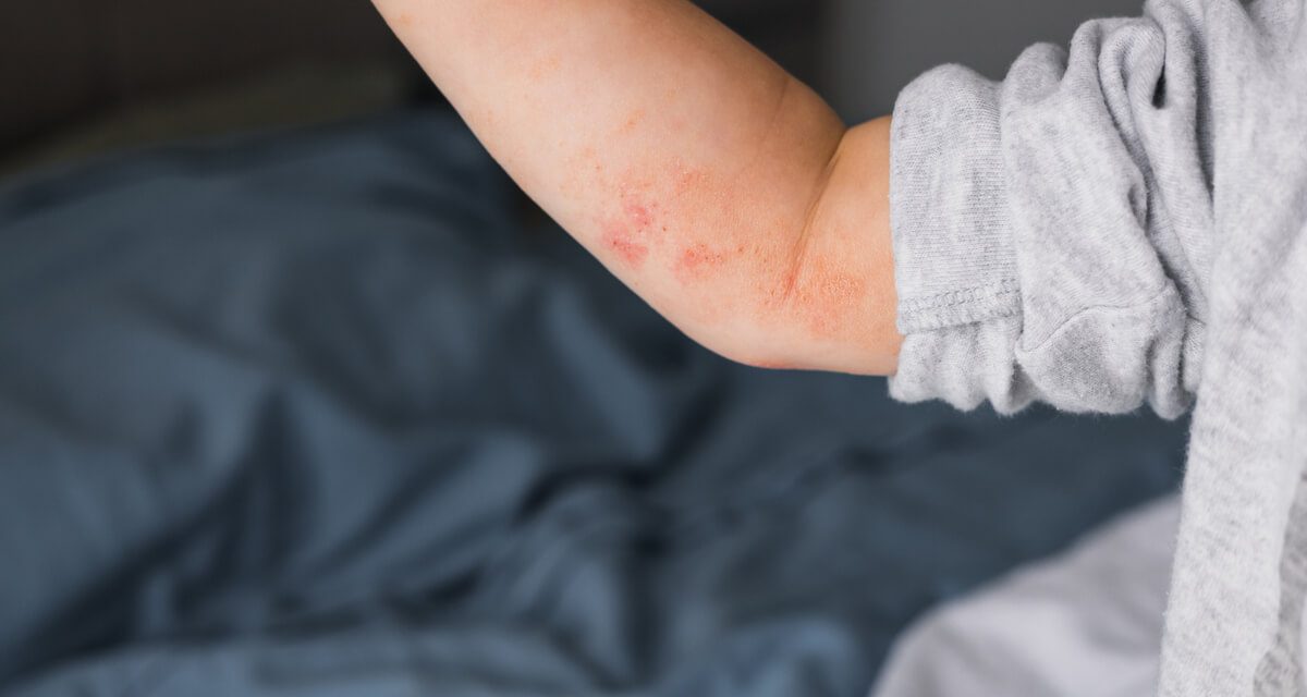 Što je atopijski dermatitis?