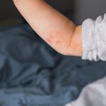 Što je atopijski dermatitis?