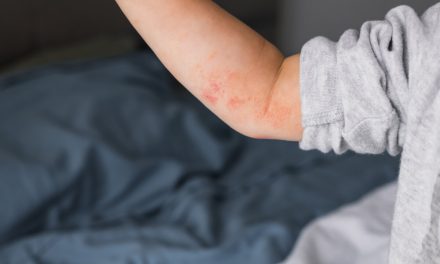 Što je atopijski dermatitis?