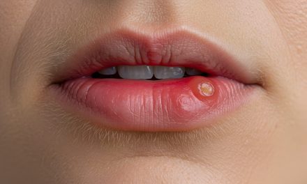 Kako se herpes prenosi?