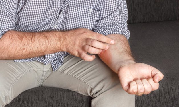 Da li psorijaza svrbi kod svih pacijenata i kako se nositi s tim simptomom?