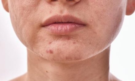 Akne na licu nisu samo estetski problem – evo zašto ih ne treba ignorirati