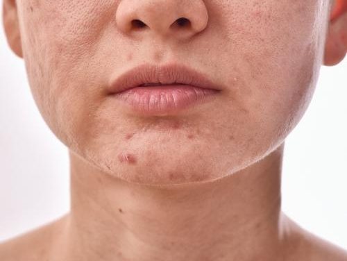 Akne na licu nisu samo estetski problem – evo zašto ih ne treba ignorirati