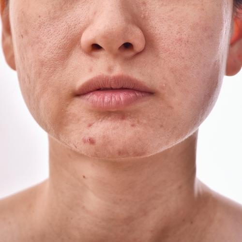 Akne na licu nisu samo estetski problem – evo zašto ih ne treba ignorirati