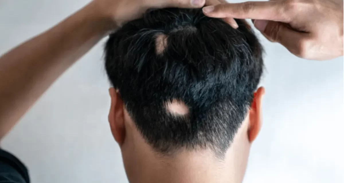 Alopecija – zašto gubitak kose nije samo estetski problem