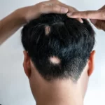 Alopecija – zašto gubitak kose nije samo estetski problem