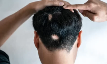 Alopecija – zašto gubitak kose nije samo estetski problem