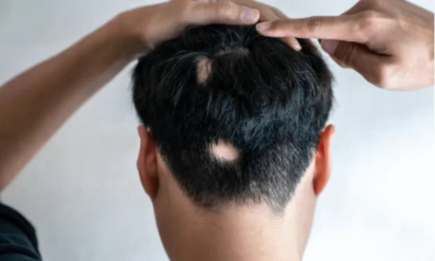 Alopecija – zašto gubitak kose nije samo estetski problem