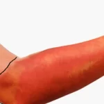 Crveni vjetar – kako prepoznati simptome i zašto je važno reagirati na vrijeme