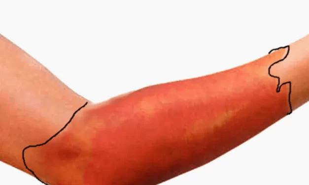 Crveni vjetar – kako prepoznati simptome i zašto je važno reagirati na vrijeme