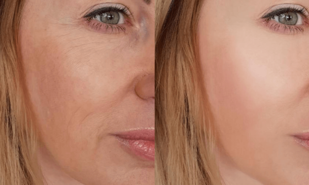 Istine i mitovi o borama oko usana: što je stvarno, a što pretjerivanje?